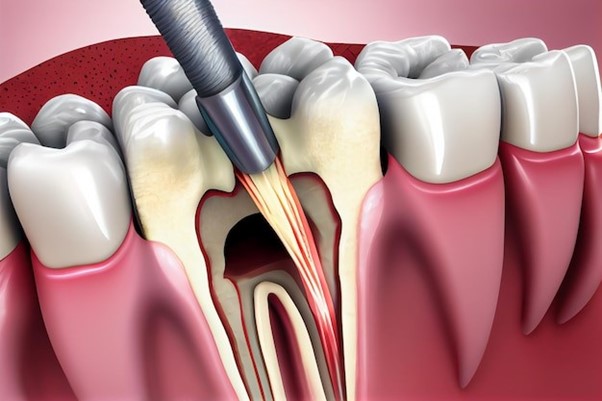 root canal