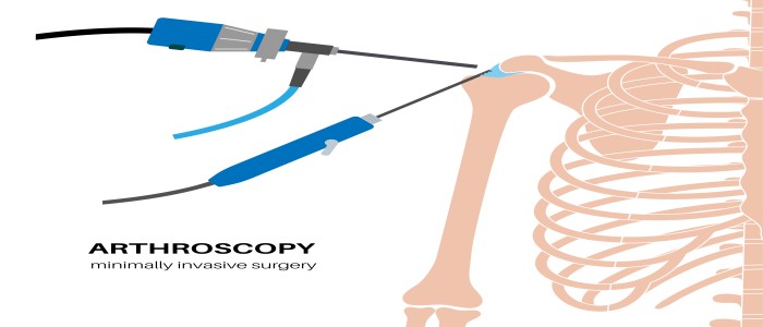 arthroscopy